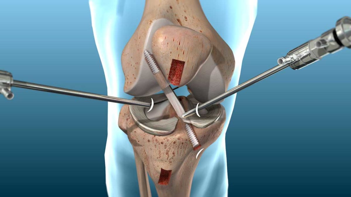 is-it-possible-to-move-after-the-acl-reconstruction-surgery